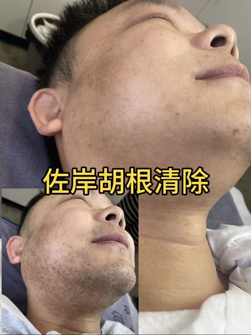 宁波脱毛
